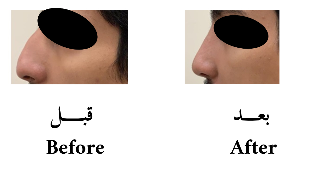 دكتور حسن الشمري عمليات تجميل و ترميم الانف تعديل جسور الأنف الجانبية لإعطاء الأنف مركز وسط الوجه