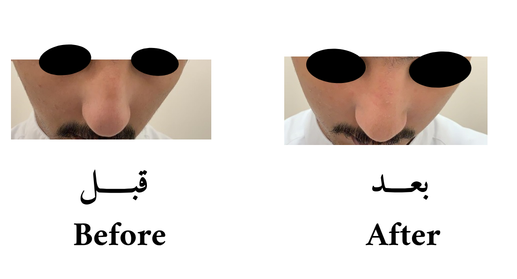 دكتور حسن الشمري عمليات تجميل و ترميم الانف تعديل جسور الأنف الجانبية لإعطاء الأنف مركز وسط الوجه
