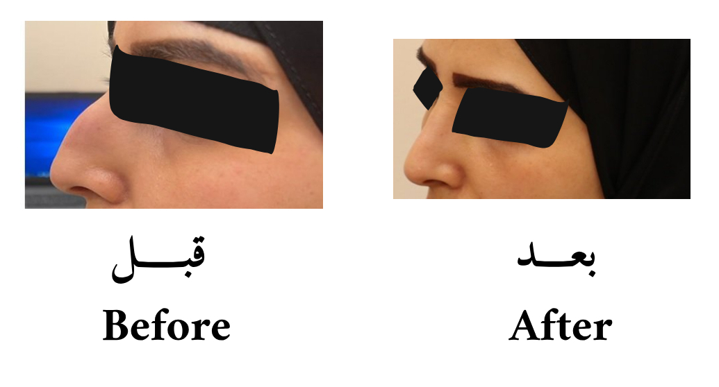 دكتور حسن الشمري عمليات تجميل و ترميم الانف إزالة حدبة الأنف الخارجية  وتعديل جسور الانف لاعطاء الأنف شكل طبيعي
