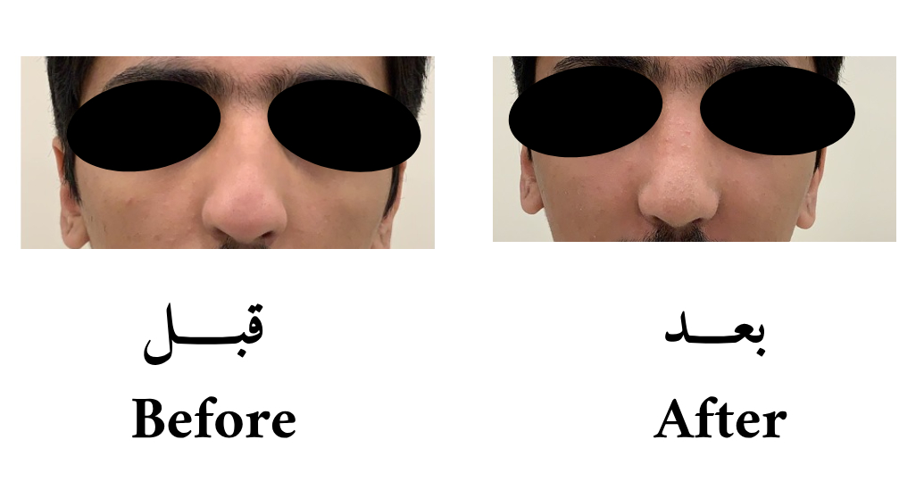 دكتور حسن الشمري عمليات تجميل و ترميم الانف تعديل جسور الأنف الجانبية لإعطاء الأنف مركز وسط الوجه